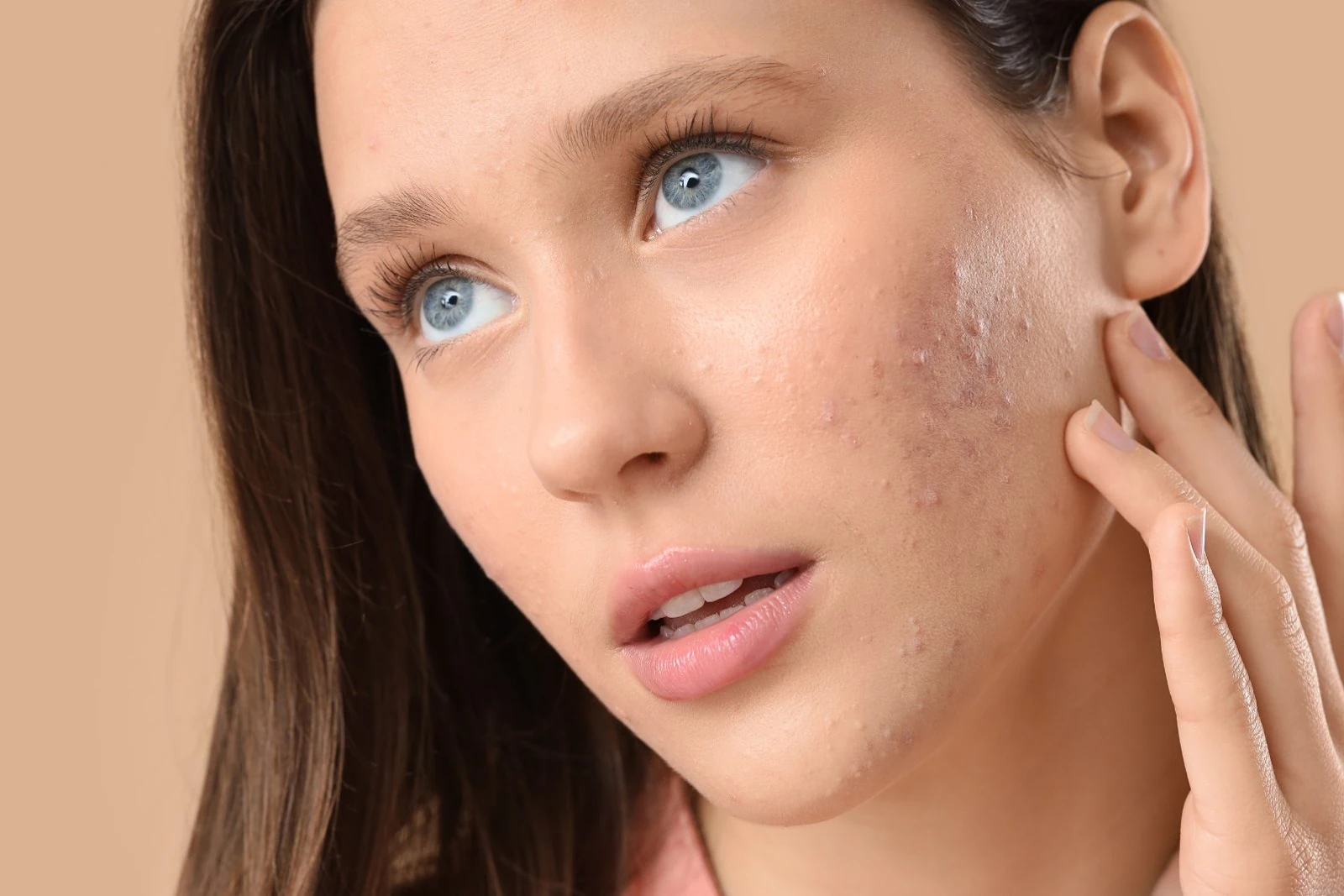 Acne and acne scarring treatment at Body Dezign House Newstead Brisbane