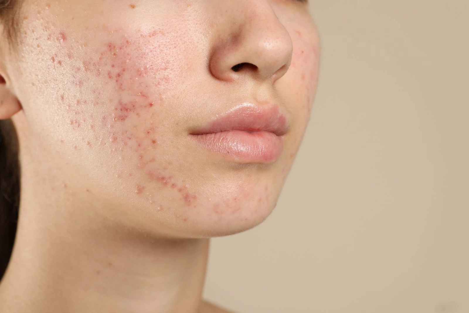 Acne scar revision and skin texture treatment at Body Dezign House Newstead Brisbane