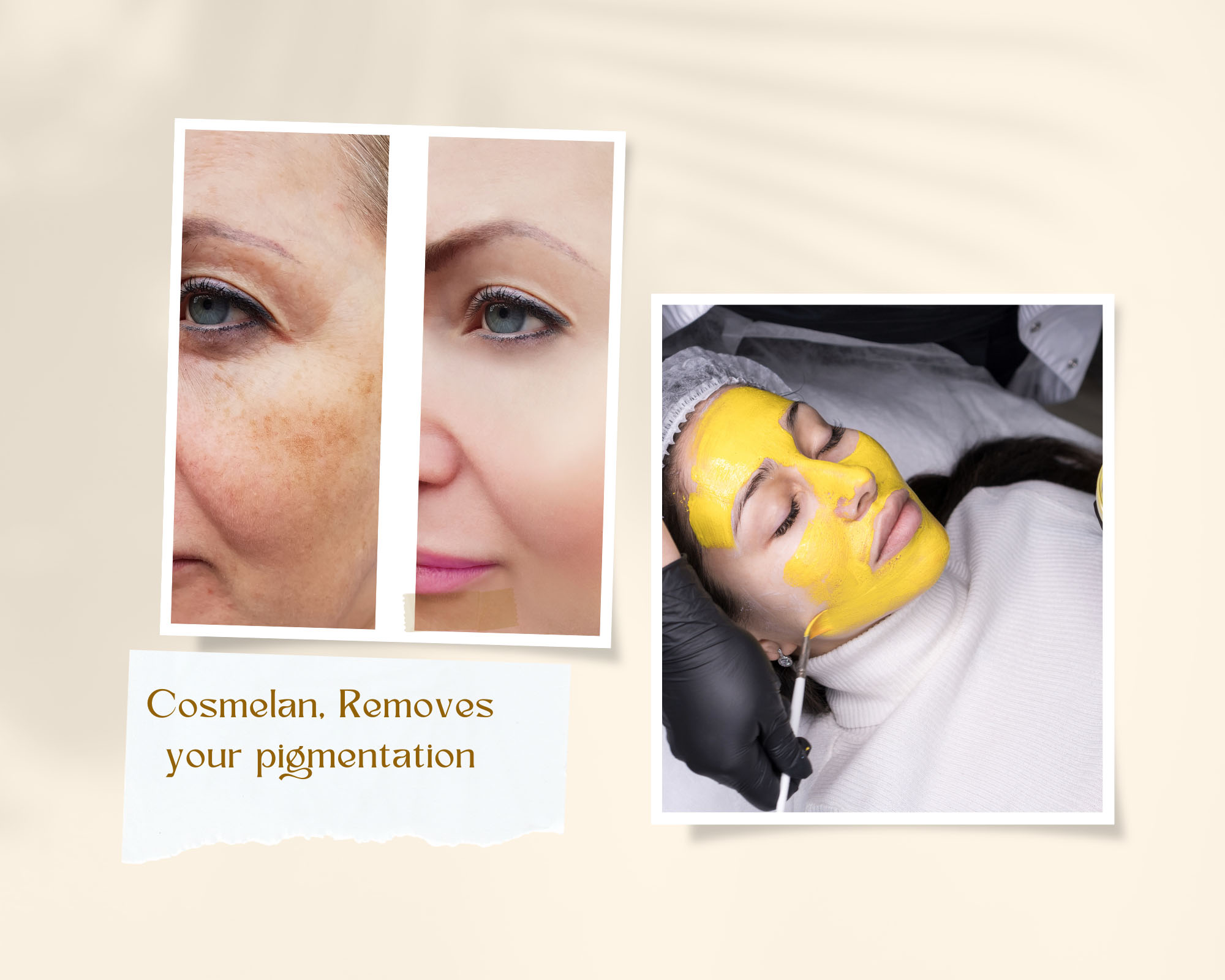 Cosmelan, Removes your pigmentation