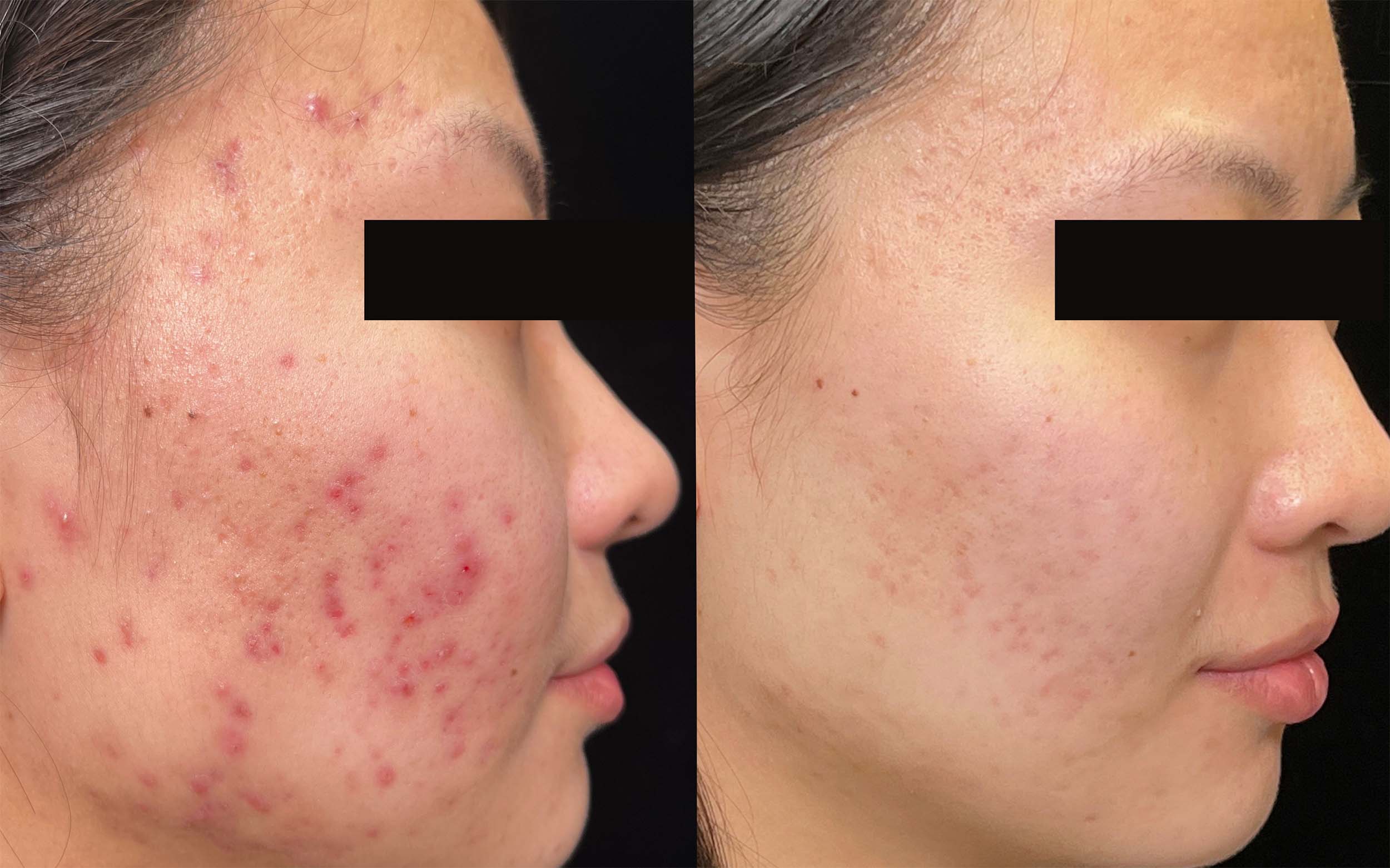 Confidence Boost: Embracing AviClear™ for Acne Treatment