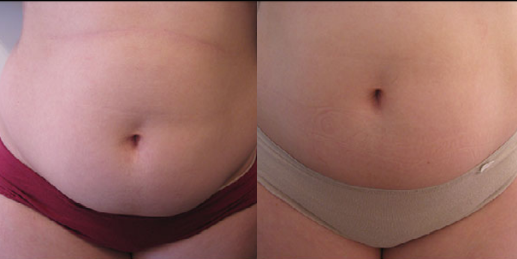 Achieve your body goals with fat reduction by fat freezing at our Brisbane clinics in Newstead and Cleveland.